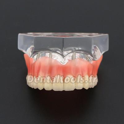 Miroir photo cristal lingual, Fourniture dentaire