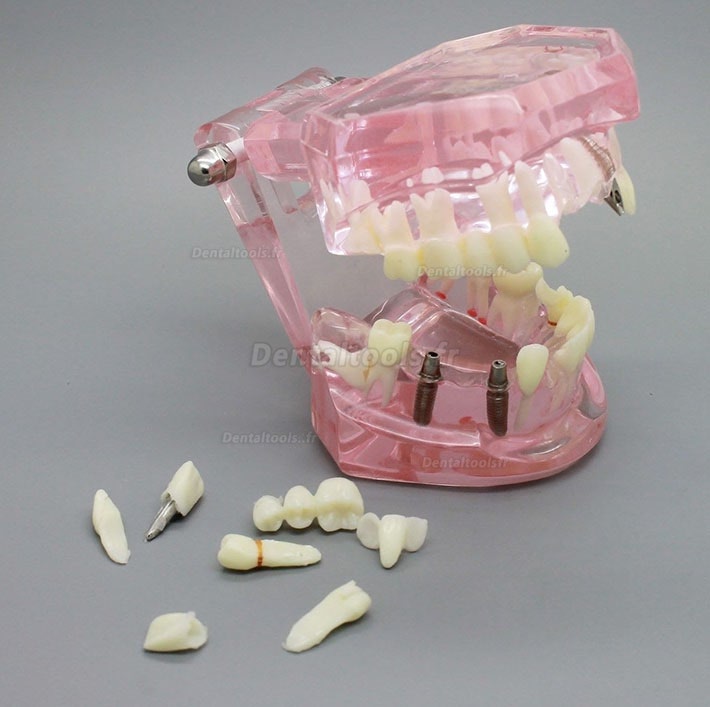 Vente de Modèle de dents de démonstration avec analyse d'étude sur implants  dentaires avec restauration 2001 rose en ligne 