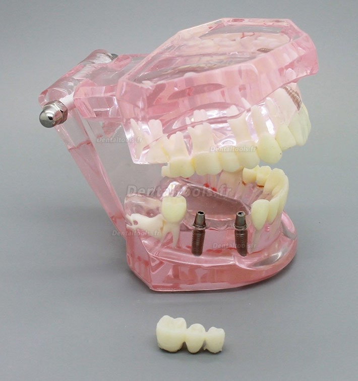 VGEBY Modèle de dents 1pc résine démonstration dentaire modèle de dent  analyse d'implant pont de couronne pour dentiste