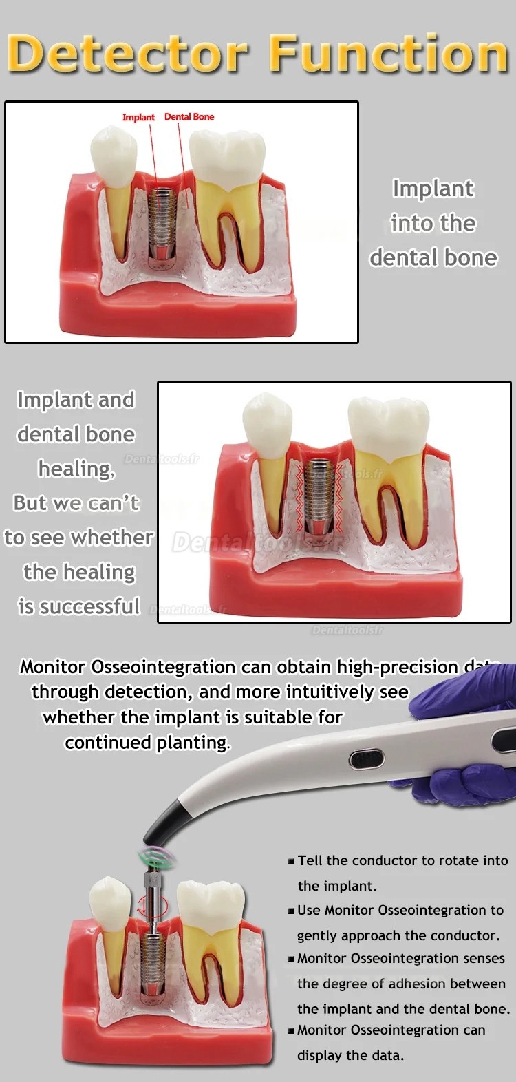 Moniteur de stabilité d'implant dentaire portable ISQ appareil de test de stabilité d'implant